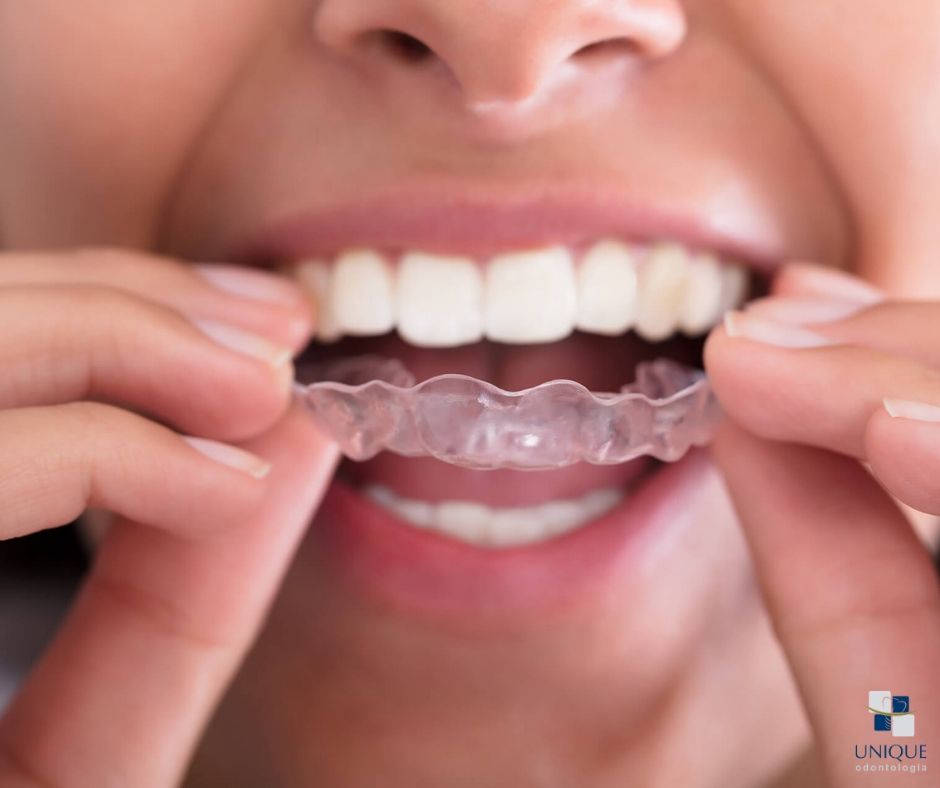 Clareamento dental: como funciona?