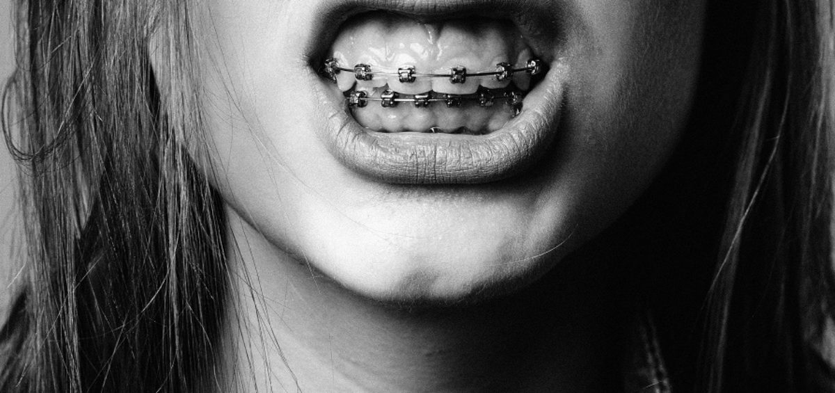 imagem mulher com aparelho dentario