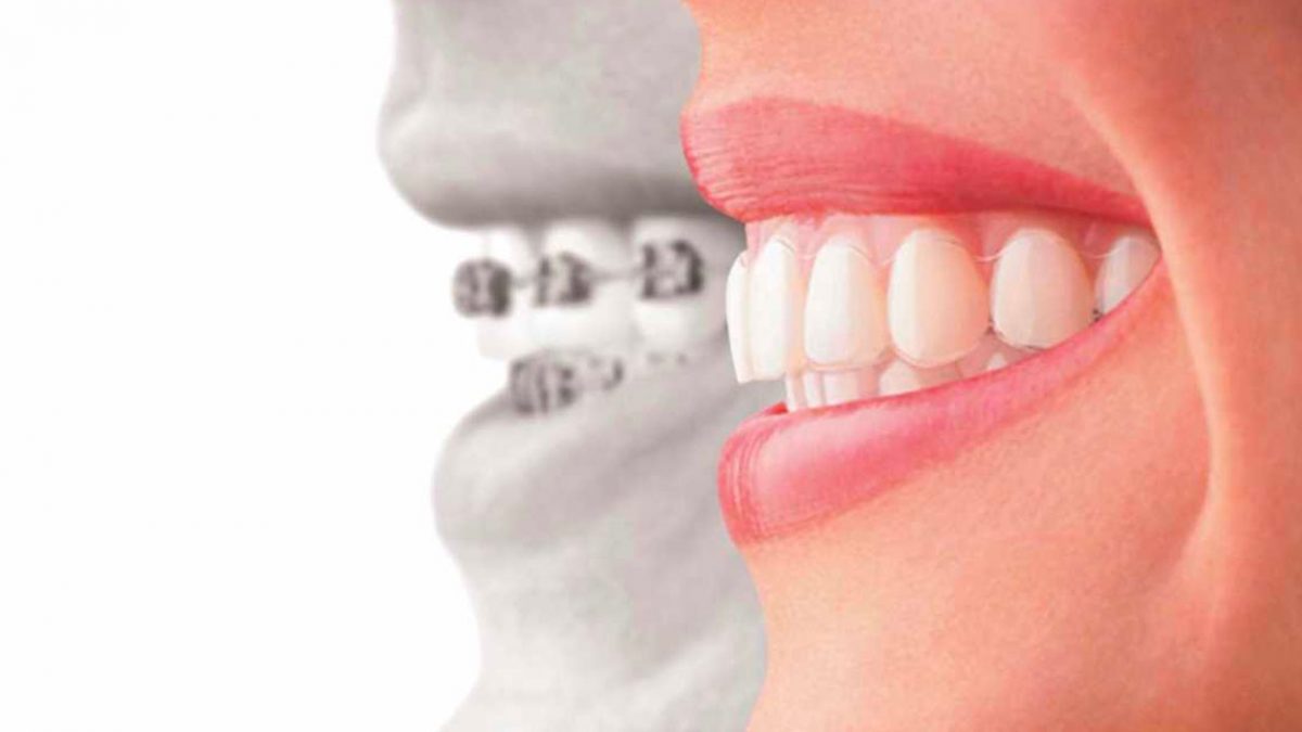 O tratamento com o aparelho invisalign é uma excelente maneira de alinhar o  sorriso de uma forma mais rápida que os outros aparelhos ortodônticos. Já  para não f…