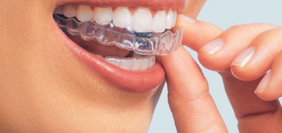 clareamento dental unique odontologia